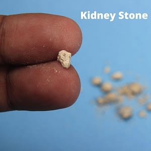 kidney stone image