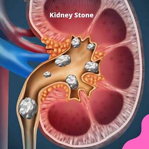 kidney stone image